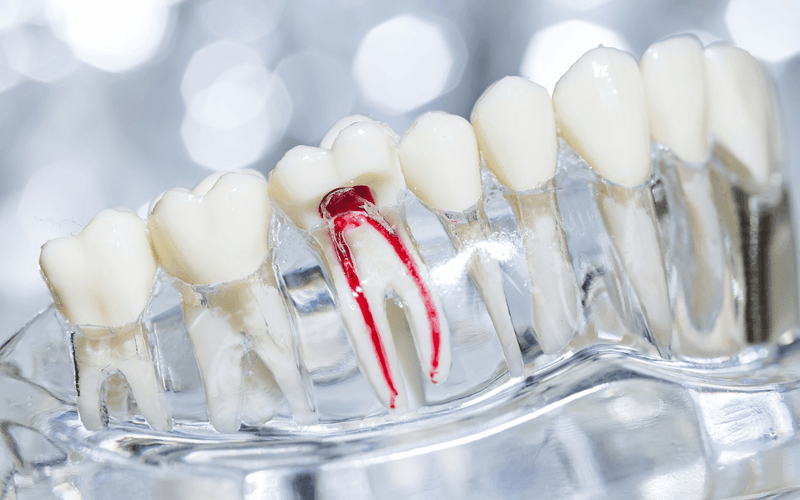 Root Canal Treatment and Retreatment